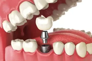Modelo de implante dentário